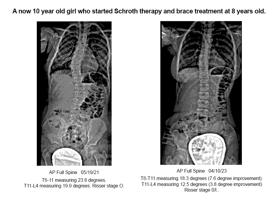 scoliois patient xrays teen