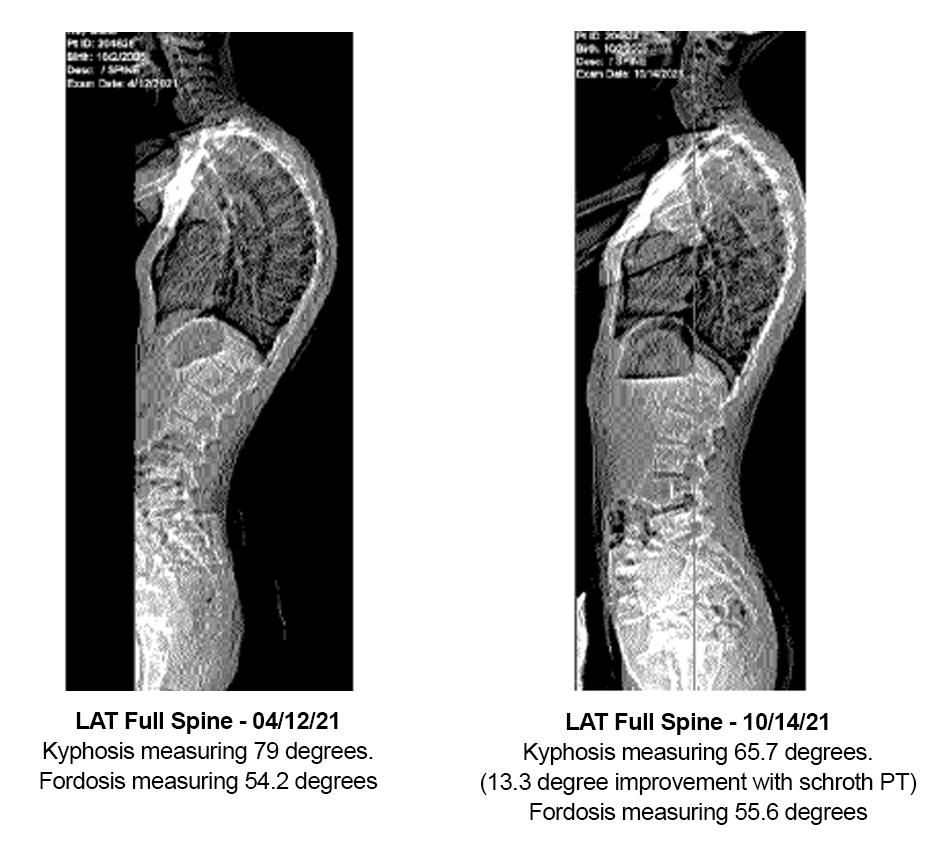 scoliois patient xrays teen