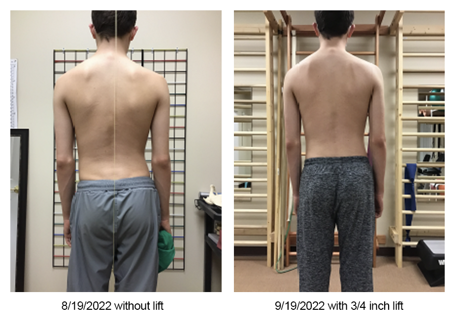 scoliois patient xrays teen